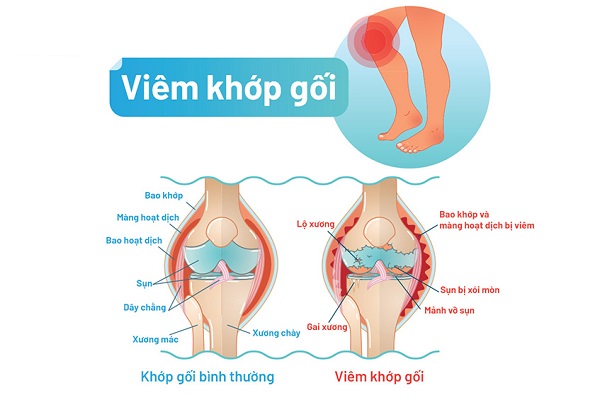 Các viêm khớp gối phổ biến gây đau khớp gối