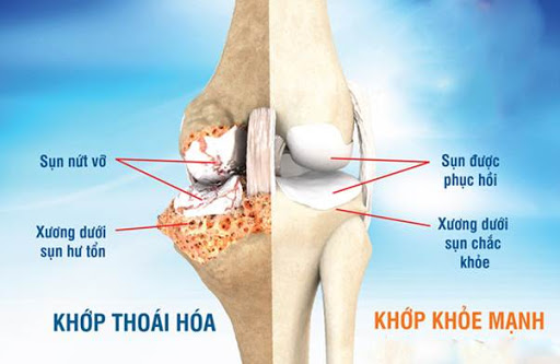 Các bệnh cơ xương khớp thường gặp - thoái hóa khớp