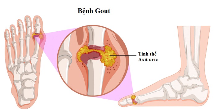 Các bệnh cơ xương khớp thường gặp - Bệnh Gout