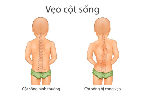 Các bệnh cơ xương khớp thường gặp