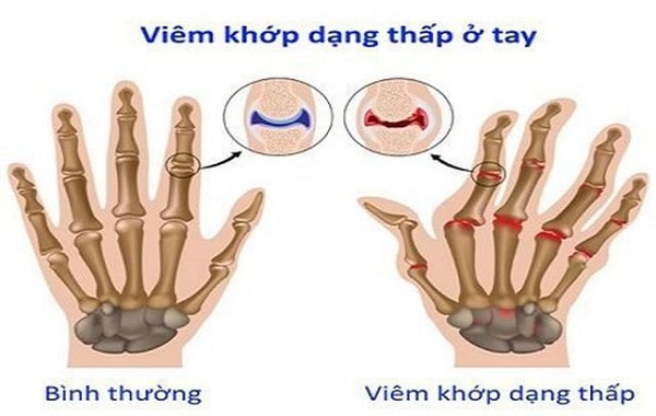 Viêm khớp dạng thấp