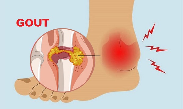 đau mắt cá chân do gout