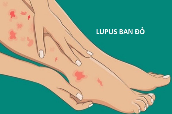 Lupus gây đau mắt cá chân